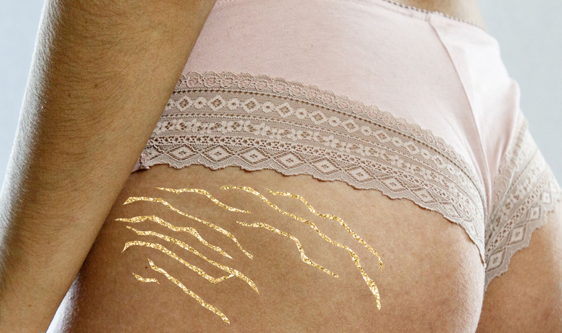 Can You Get Rid of Stretch Marks?