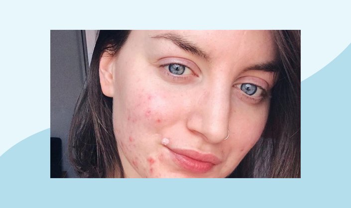 InMySkin: @SkinWithLea Teaches Us How to Manifest Clear Skin