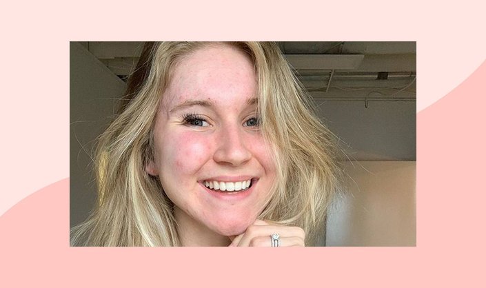 #InMySkin: Skin Positivity Influencer Sophie Gray Talks About Her Mission to Normalize Acne