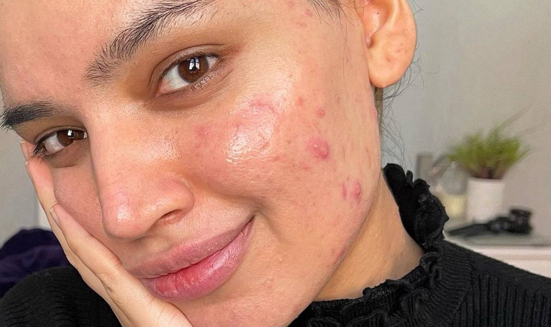 flaskehals Dag kursiv Makeup-Free Selfies From Skin-Positivity Influencers | Skincare.com