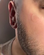 Should You Cover a Popped Pimple With Makeup? A Dermatologist Weighs In