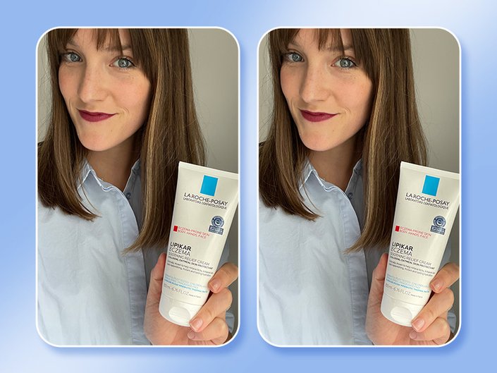 person holding eczema cream