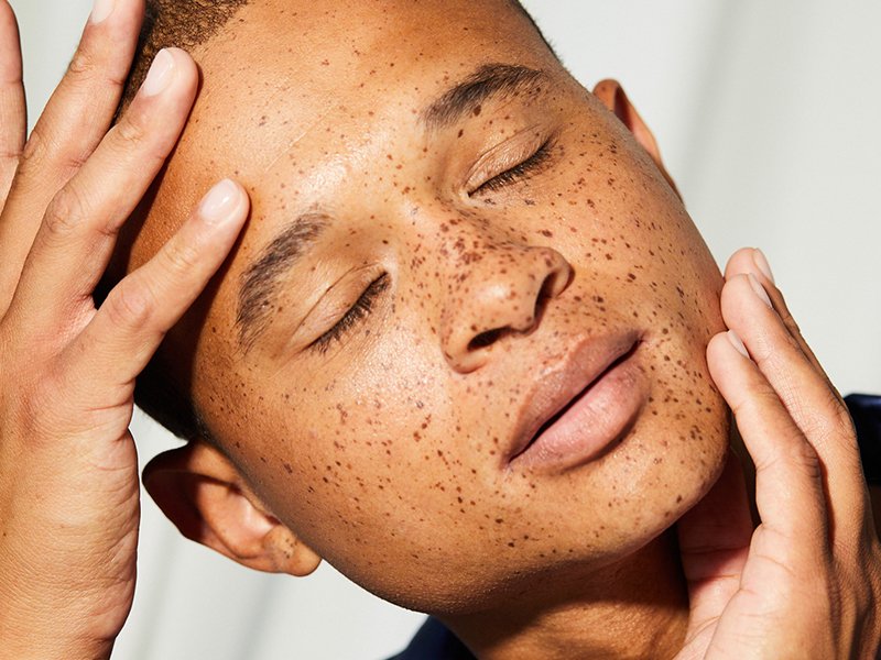 Image of a male model with freckles touching his head and the sides of his face