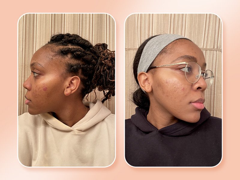 Selfie of editor with her face turned to the side before using Vichy LiftActiv Dark Spot Serum and a selfie after eight weeks of using it, collaged on a peach background