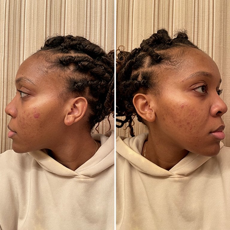 Side by side selfies of editor showing each side of her face after one week of using the Vichy Dark Spot & Wrinkle Serum