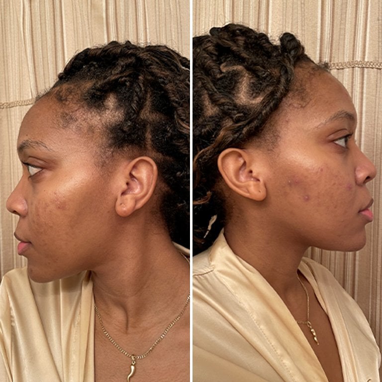 Side by side selfies of editor showing each side of her face after four weeks using the Vichy LiftActiv Dark Spot and Wrinkles Serum