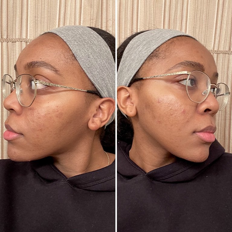 Side by side selfies of editor showing each side of her face after 8 weeks of using the Vichy Dark Spot & Wrinkle Serum