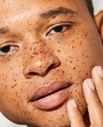 person with freckles touching their face