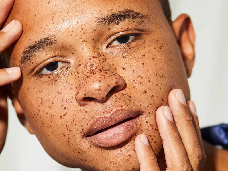 person with freckles touching their face 