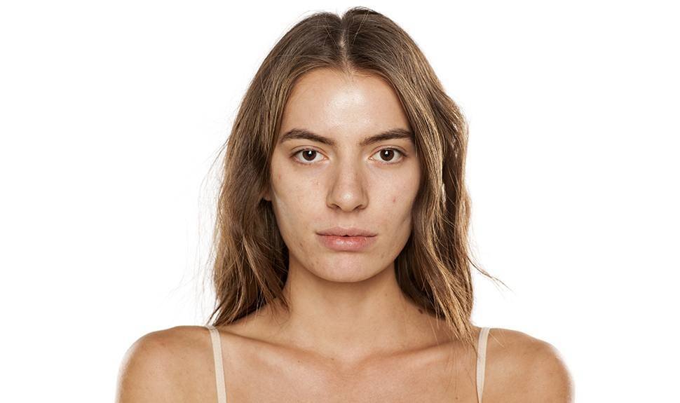 How the "Acne Positivity" Movement Is Fighting the Stigma Around Breakouts