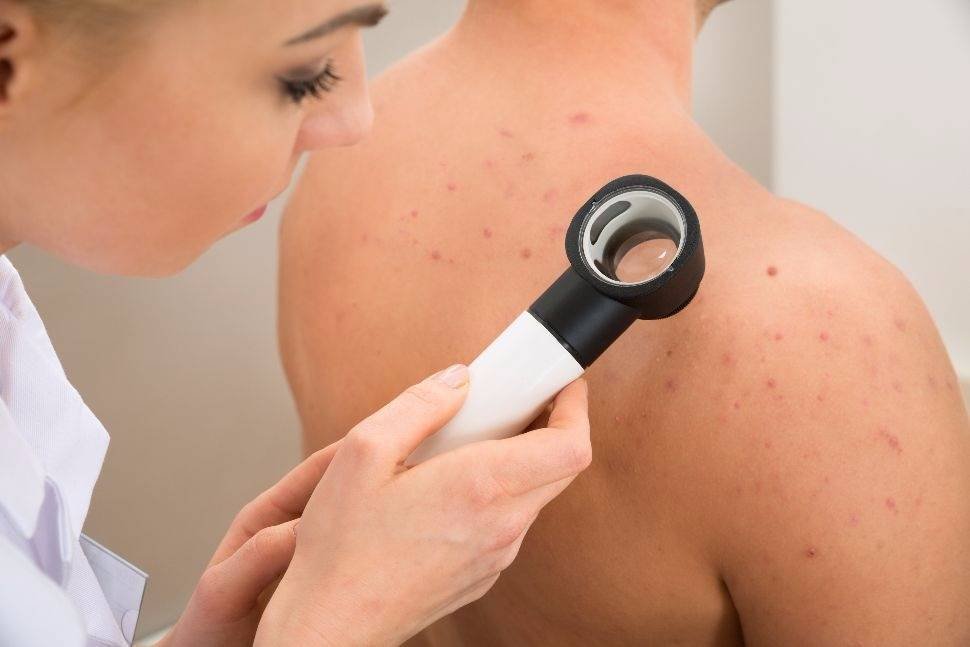 how can i get rid of acne on my body