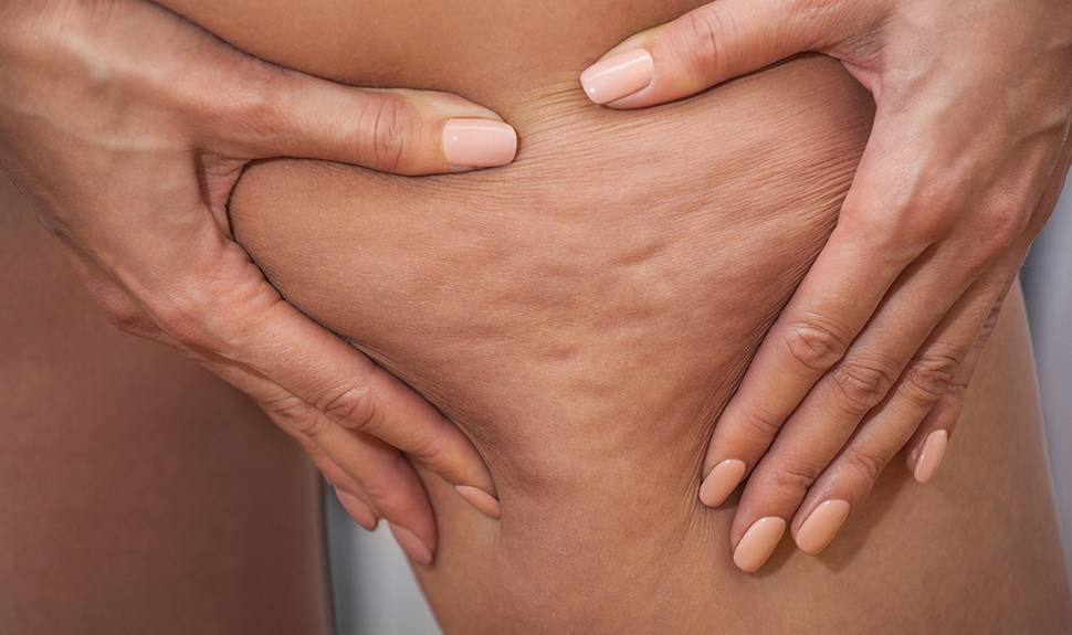 6 Cellulite Myths You Don't Want to Fall For