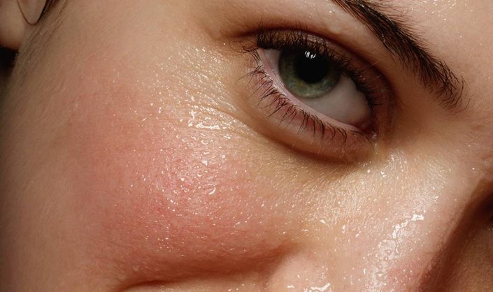 Your Burning Rosacea Questions, Answered